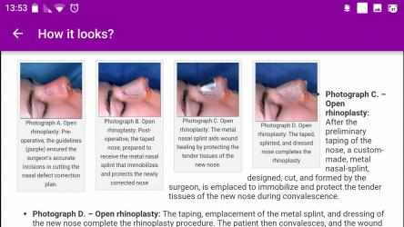 Screenshot 2 Nose job - Rhinoplasty plastic surgery windows