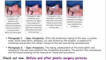 Captura 4 Nose job - Rhinoplasty plastic surgery windows